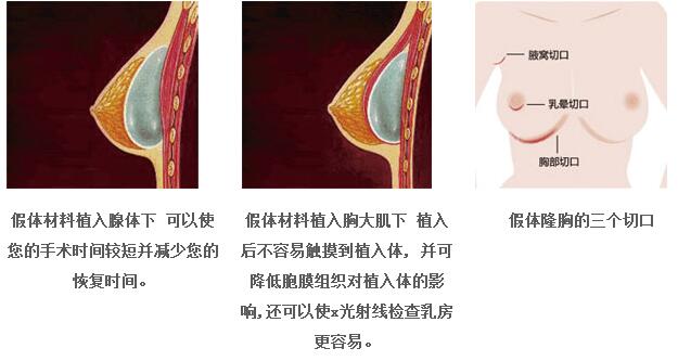 北京哪种隆胸假体比较好