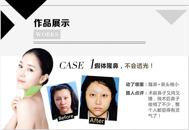 北京八大处整形医院王克明假体隆鼻怎么样