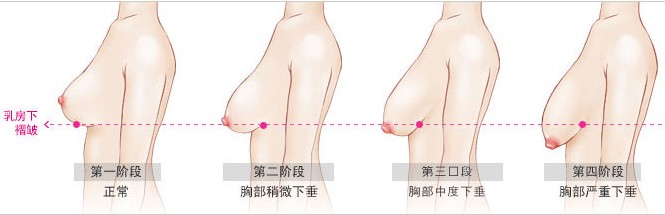 福州乳做乳房下垂整形手术哪家医院好