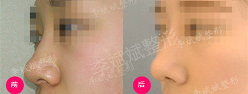 硅胶隆鼻、耳软骨+鼻中隔软骨延长鼻尖、鼻头缩小后1个月