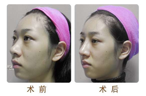 北京八大处马继光隆鼻对比案例