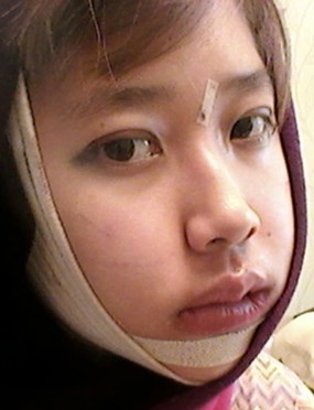 两颚、颧骨、兜下巴、双眼皮