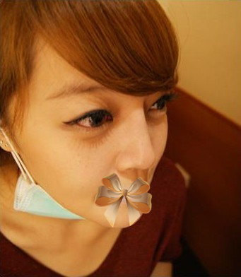 膨体隆鼻、自体软骨