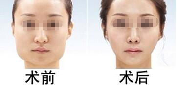     北京美莱下颌骨磨骨经典案例
