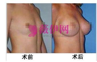 自体脂肪隆胸术后恢复案例图