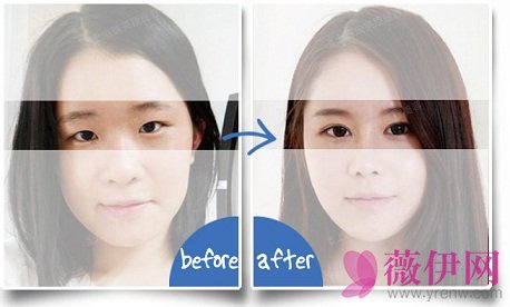 李桂珍割双眼皮经典案例