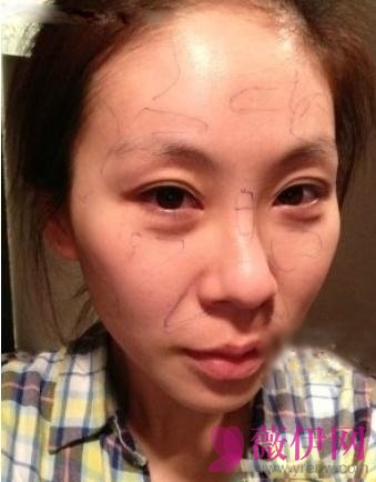 自体脂肪丰太阳穴果对比