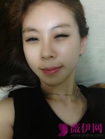 自体脂肪丰太额头果对比