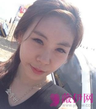 自体脂肪丰面颊果对比
