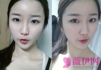 自体脂肪丰太阳穴多少钱