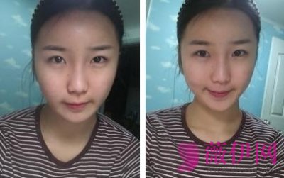 自体脂肪丰太阳穴多少钱