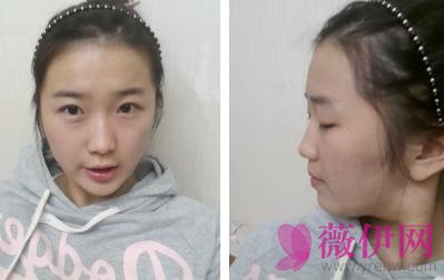 自体脂肪丰额头多少钱