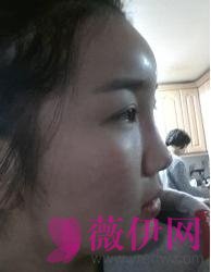 自体脂肪丰额头多少钱