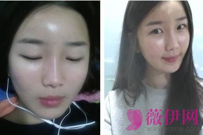 自体脂肪丰太阳穴多少钱