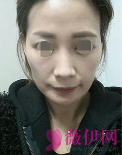 自体脂肪填充面部前后对比