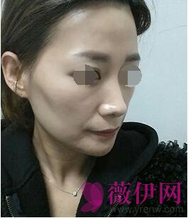 自体脂肪填充面部前后对比