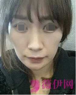 自体脂肪填充面部前后对比