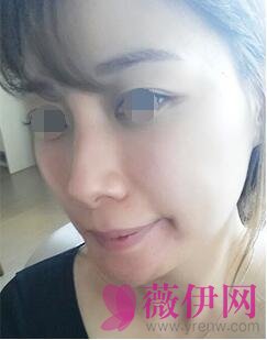 自体脂肪填充面部前后对比