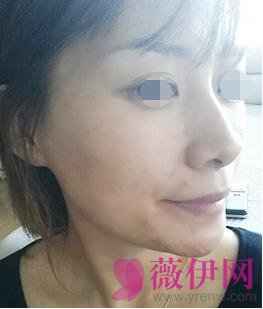 自体脂肪填充面部前后对比