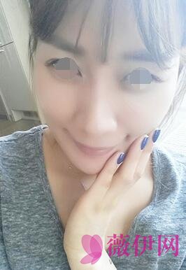 自体脂肪填充面部前后对比