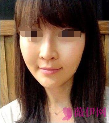 自体脂肪填充脸颊果对比