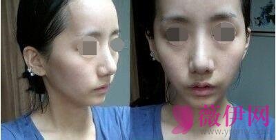 自体脂肪全脸填充+垫下巴