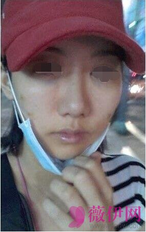 自体脂肪全脸填充+垫下巴
