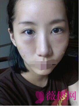 自体脂肪全脸填充+垫下巴