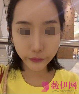 自体脂肪全脸填充+垫下巴