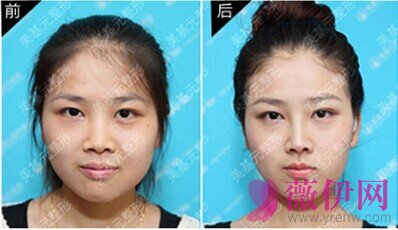 武汉美基元汪福强隆鼻案例