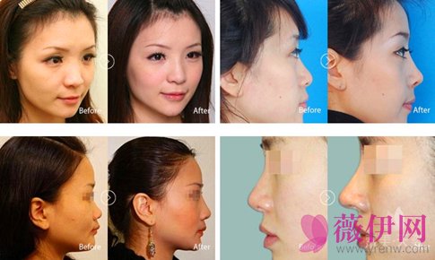 成都素美天资杨迪隆鼻案例