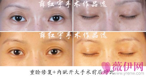 薛红宇双眼皮修复案例