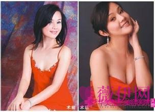 李健隆胸案例