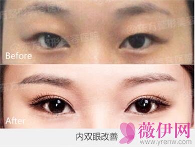 双眼皮修复