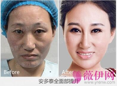 安多泰隐提升除皱