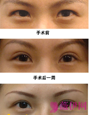 计菁双眼皮案例