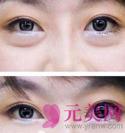 去眼袋前后对比照片