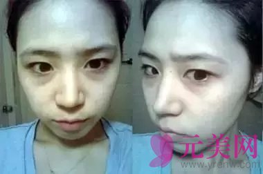 王绍国做自体脂肪填充全脸真人案例