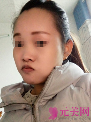 张先智隆鼻