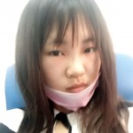 假体隆鼻术后真实案例恢复过程日记