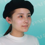 北京东方瑞丽假体隆鼻真实案例分享