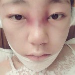 北京假体隆鼻+自体脂肪面部填充面部真人日记