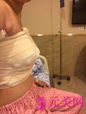 自体脂肪隆胸手术真人恢复过程日记 前后对比照片