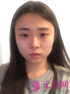 做完鼻部手术+眼部手术手术果前后照对比变化