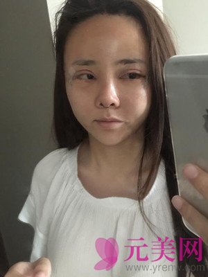 做完鼻部手术+眼部手术手术果前后照对比变化