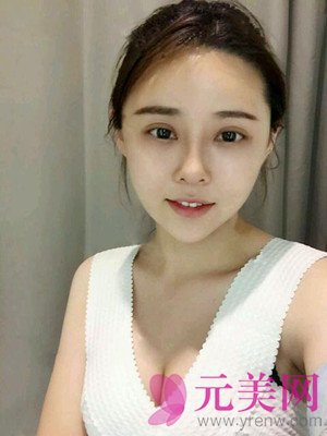 做完鼻部手术+眼部手术手术果前后照对比变化