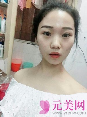 北京垫下巴+硅胶假体隆鼻手术前后对比恢复过程日记
