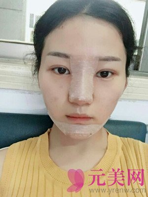 北京垫下巴+硅胶假体隆鼻手术前后对比恢复过程日记