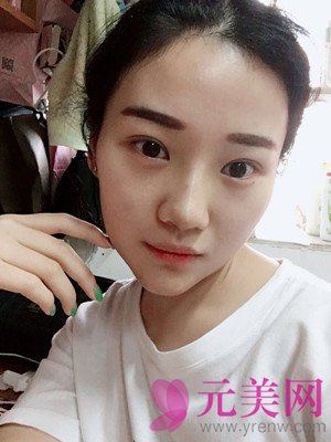 北京垫下巴+硅胶假体隆鼻手术前后对比恢复过程日记