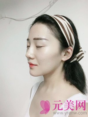 北京垫下巴+硅胶假体隆鼻手术前后对比恢复过程日记